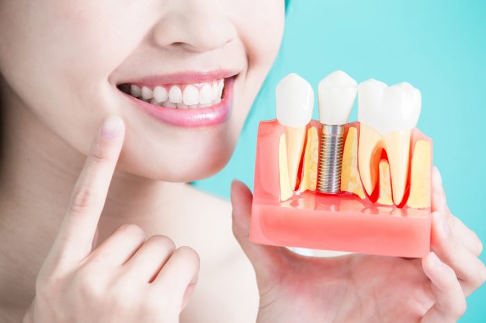 Discover What An Expert Has To Say On The Dental Implants