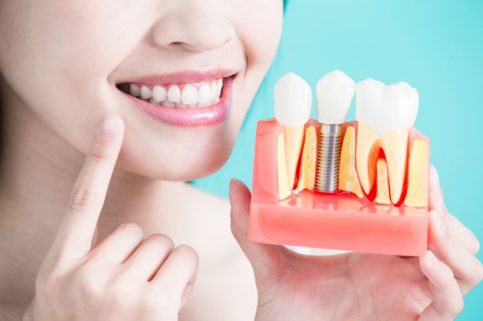 Find Out What A Professional Has To Say About The Dental Implants